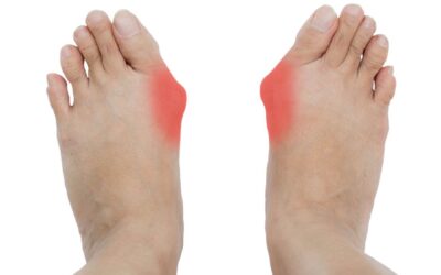 Vaivaisenluu eli Hallux valgus